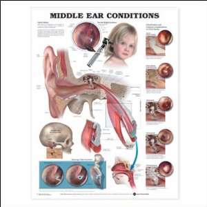  Middle Ear Conditions Anatomical Chart 20 X 26 