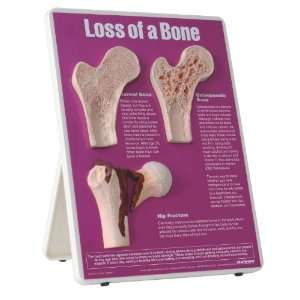 3B Scientific W43124 Loss of Bone Easel Display, 9 Length x 12 