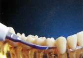 dental Piezo Ultrasonic Scaler K5 DTE satelec  
