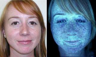   PhotoSAM II Camera System Skin Scanner UV Analysis Combination  